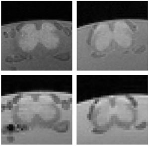 MRI-based morphometric structural changes