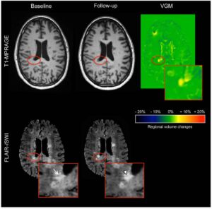 vgmorph Venous Diameter Changes